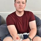 teen burned due to iphone